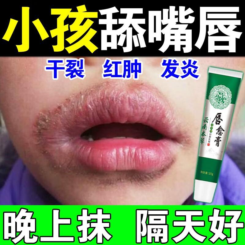 药房直售 唇炎专用修复药慢性唇炎嘴唇干裂脱皮红肿儿童口角炎唇 1盒