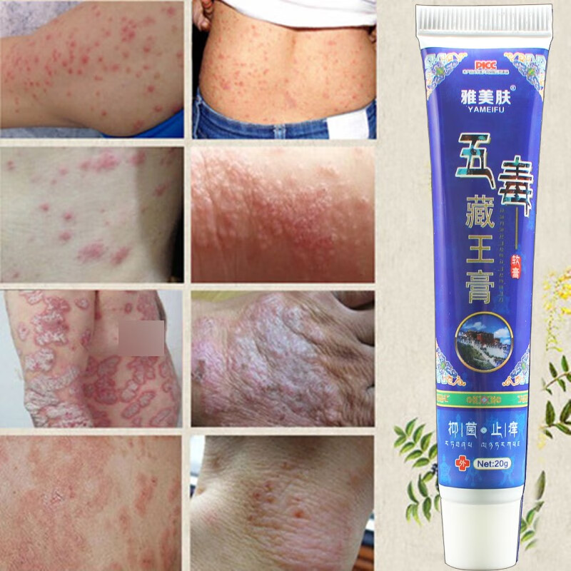 肤毒净病癣根净屑银癣外用癣痒灵皮肤止痒膏癣股治成人阴囊疹湿肛门瘙痒藓手草本癣痒净牛皮肤效癣足手斑汗雅美肤五毒藏王膏现货 虎窝购