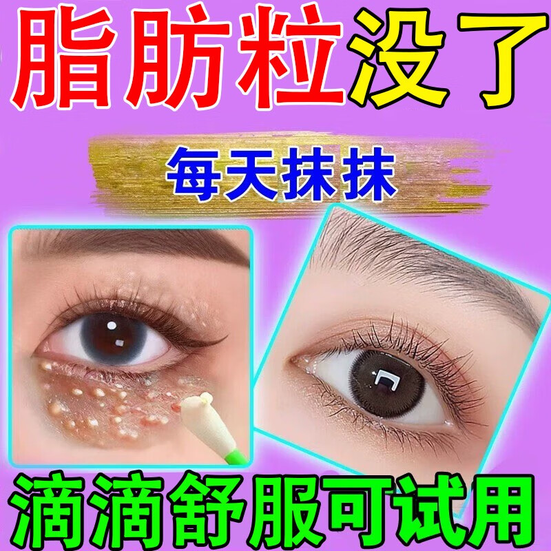 脂肪粒不去除神器眼部专用油脂粒脂肪粒汗管瘤眼周白色颗粒黑眼圈 单