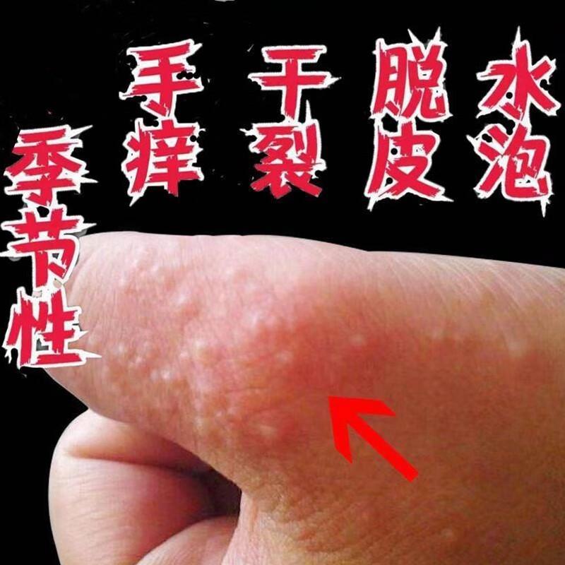 韩芭莎手上起小水泡脱皮很痒手痒起小水泡抑菌膏汗泡膏 一瓶装