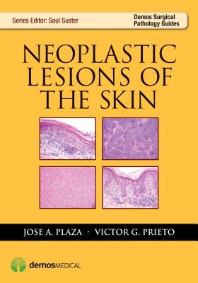 预订neoplastic lesions of the skin