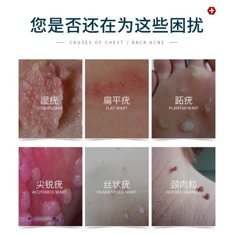 时珍世家扁平疣专用疣体脱落膏 跖疣脚底趾疣去i根祛疣膏 丝状疣 一盒