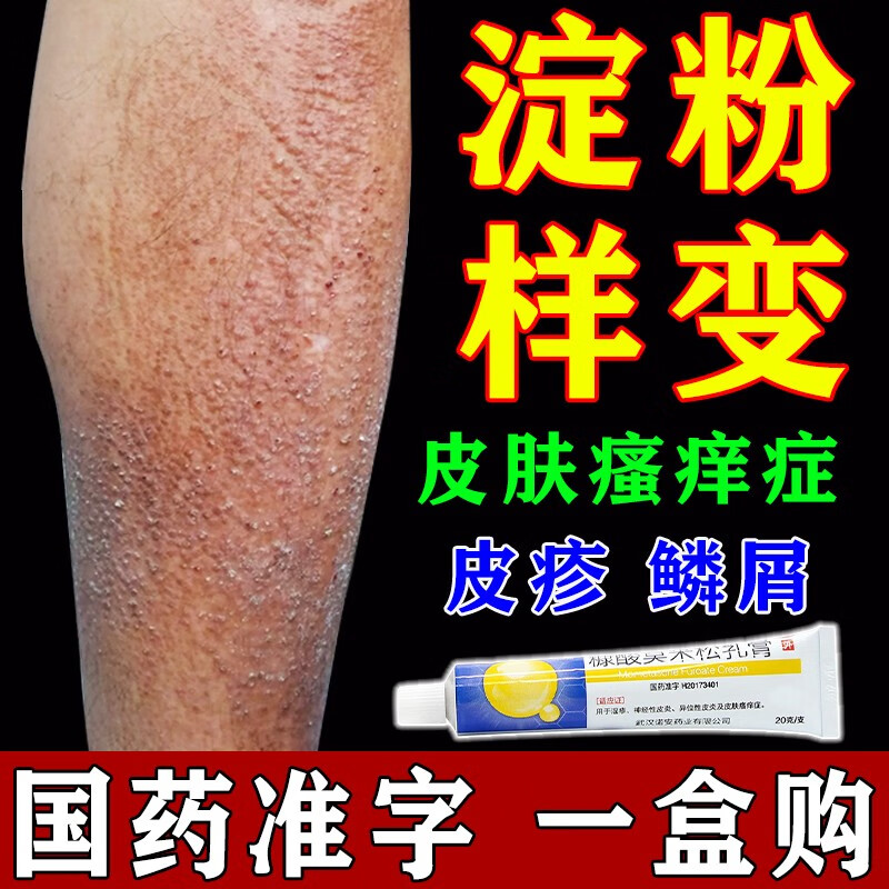 皮肤淀粉样变皮肤病 瘙痒症皮疹鳞屑神经性皮炎湿疹皮肤 糠酸莫米松