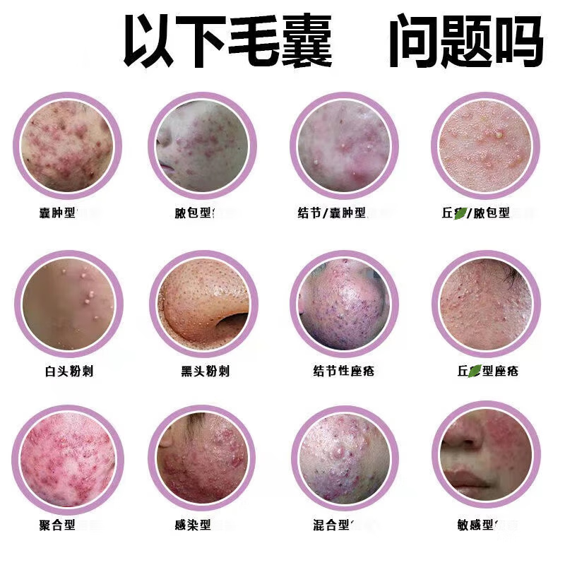 【毛囊皮炎硫磺皂洗痘皂全身适用】痘痘螨虫皂硫磺香皂洗脸洗头沐浴皂