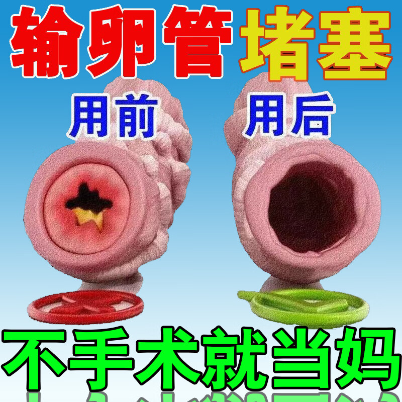 【jd健康】【一贴好孕】疏通输卵管堵塞不通畅盆腔粘连积水积液不 一