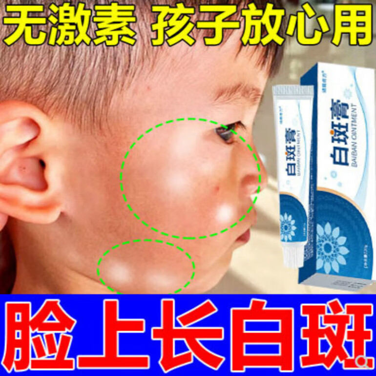 儿童白色糠疹小孩脸上白专l用药起藓干鳞屑桃花玫瑰糠疹 玫瑰糠疹膏