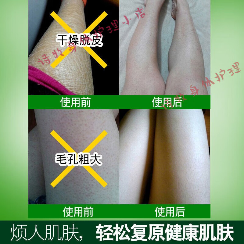 帝斯曼手臂上的皮肤疙瘩毛囊角化角质胳膊上的小疙瘩 毛周角化 毛周