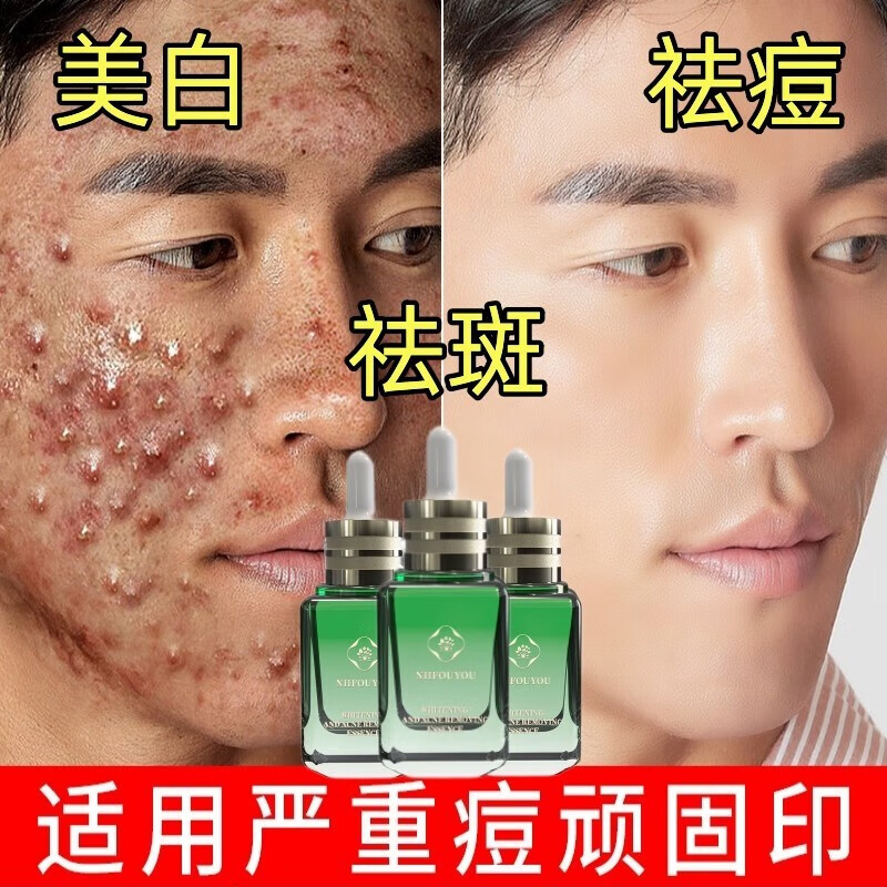 NHFOUYOU美白淡斑祛痘精华液淡化痘印水杨酸黑色素黑头粉刺提亮肤色护肤品 60ml【轻度痘肌斑点适用】
