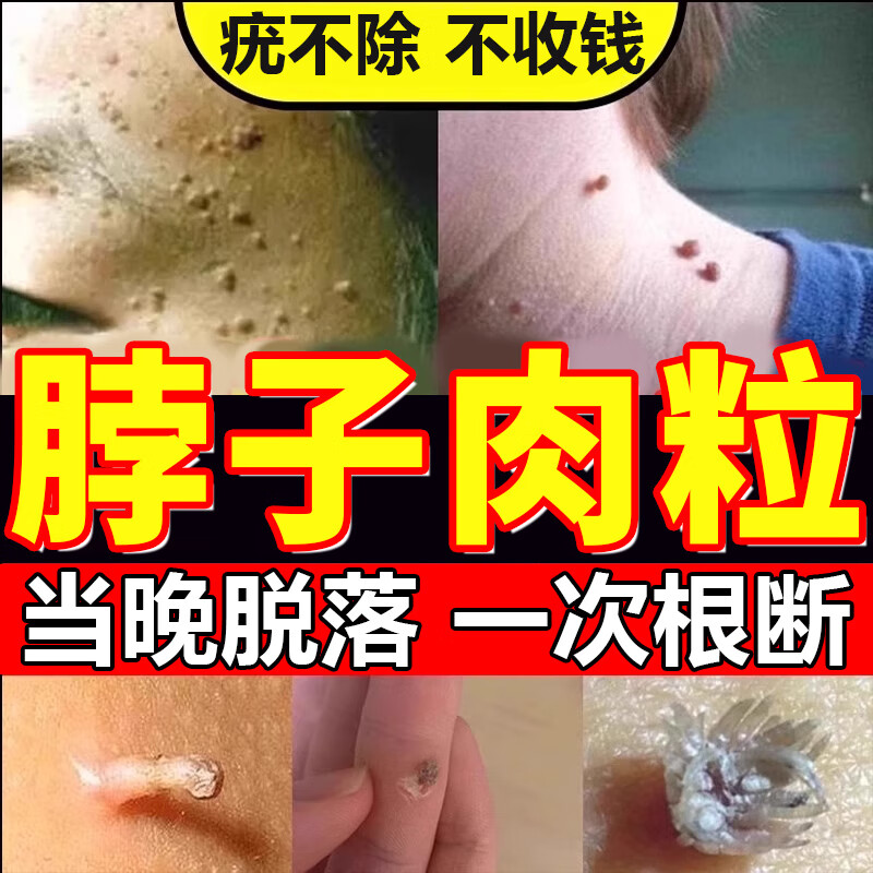 去i疣灵扁平疣面部脖子瘊子疣瘊去除脖子小肉粒疣体专用特傚效药 单