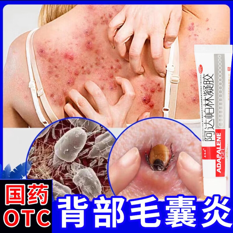 毛囊炎背部药膏 螨虫药膏背部 后背毛囊炎除螨祛痘胸部脸部 皮肤用药