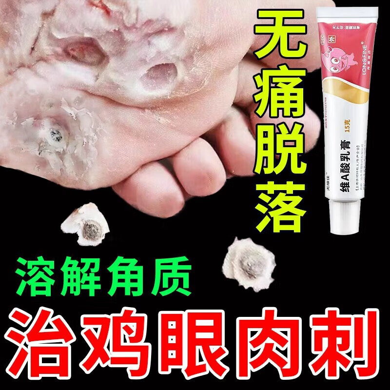 鸡眼专用药 治鸡眼的药膏 鸡眼无痛脱落 脚底脚趾长鸡眼刺猴跖疣老茧