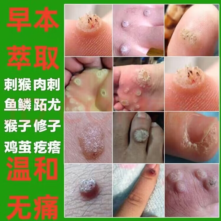 京胜草本克l疣液脖子膏颈部体私处尤立净灵液腋下皮赘肉粒疙瘩 单盒装