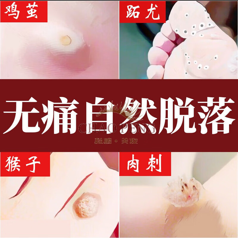 【无痛去鸡i眼】鸡i眼膏贴去老茧脚茧厚茧死皮脚底脚趾脚垫鸡i眼神i器