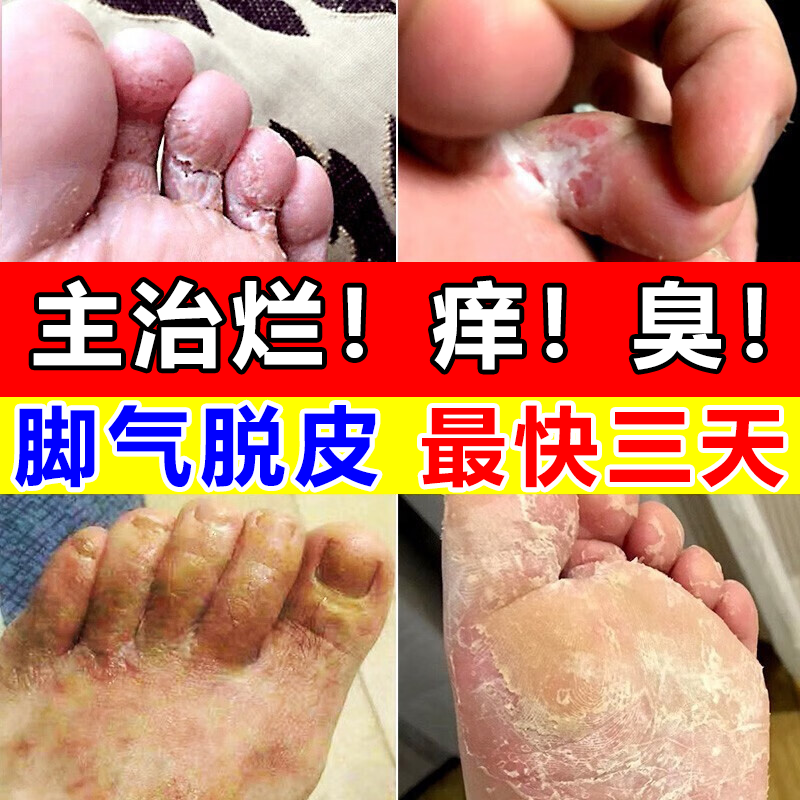 九芝堂足光散泡脚药包脚气药止痒脱皮烂脚丫水泡糜烂真菌感染除脚气