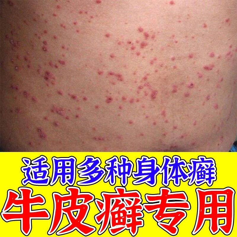 牛皮丨癣专用顽固牛皮丨癣银屑丨病头皮癣皮肤癣涂膏皮肤瘙痒手抑菌膏