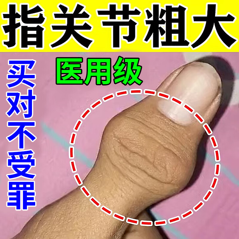 药膏药消肿止痛关节疼风湿类风湿用药风湿手指关节疼痛变形肿大僵硬