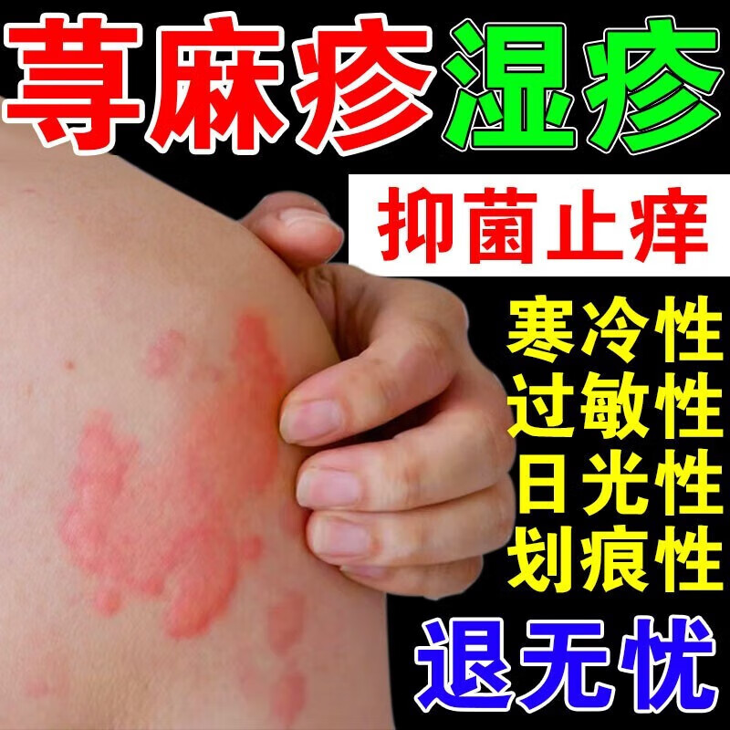 荨麻丘疹过敏止瘙痒断毒根膏反复急慢性荨麻丘疹皮肤瘙痒风团专用