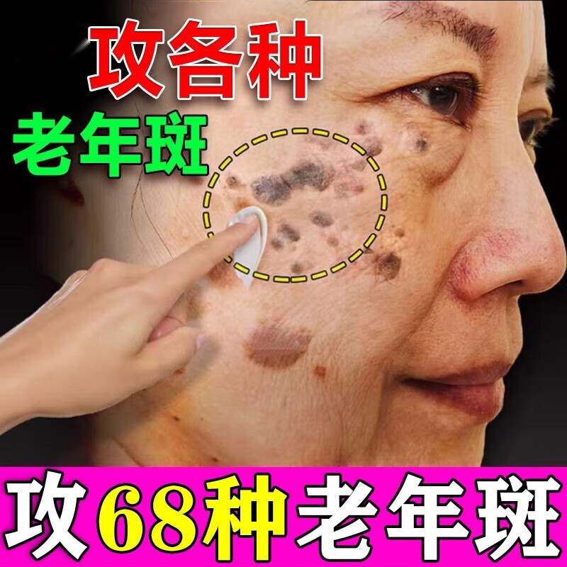 氢醌乳膏 黄褐斑去老年斑脸部专用膏祛斑霜药去老人斑黑斑淡斑美白