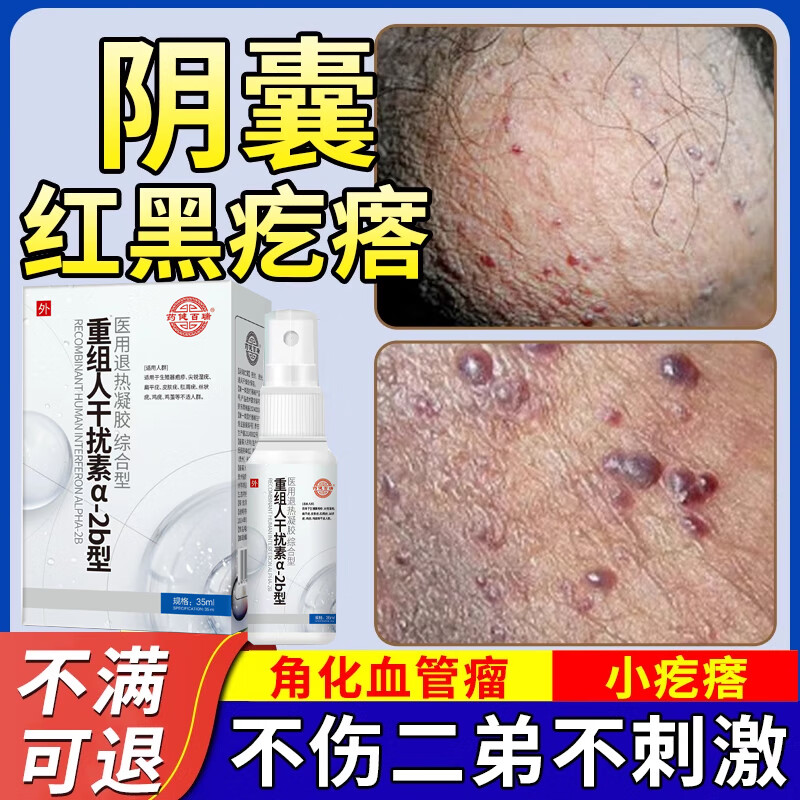 阴囊血管角化瘤私处红黑疙瘩睾丸血管痣蜘蛛痣血泡男人角皮用专药 买