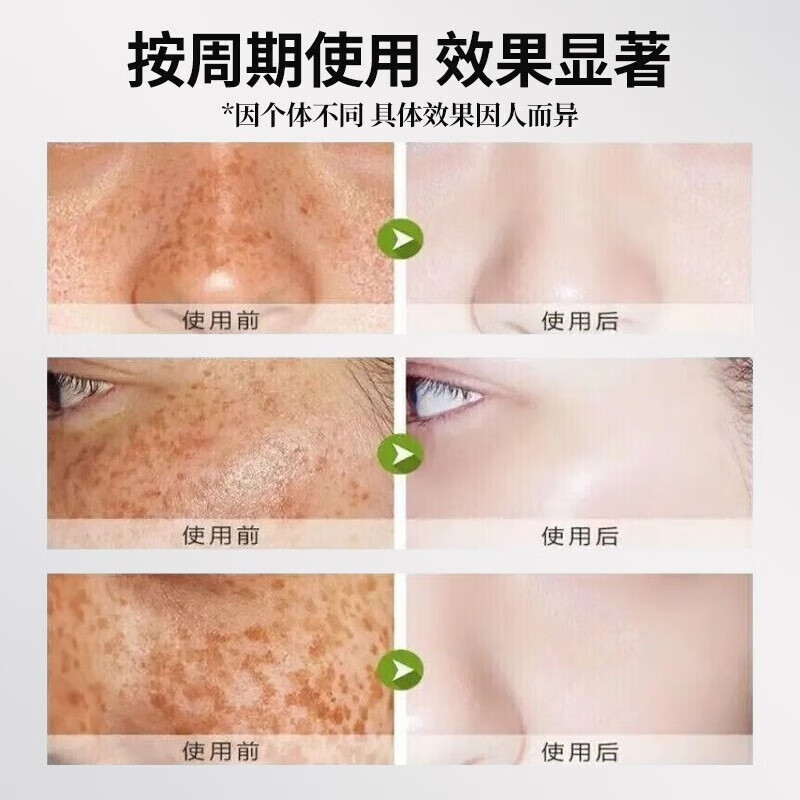 【医I美院线】氨甲环酸精华液传明酸湿敷注射液黄褐斑美白祛斑提亮肤色改善暗沉补水保湿烟酰胺原液小白瓶O 三瓶装【溶斑油不反黑】