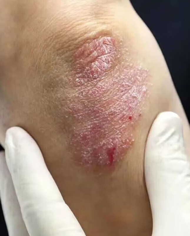 顽达康【顽毒净】日本配方牛l皮顽l癣湿诊软膏成人儿童治皮l炎荨l麻l