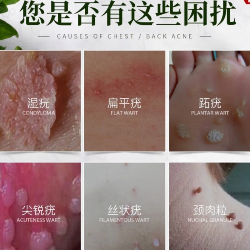 克尤膏去i疣膏克疣液扁平疣丝状疣尖锐湿疣瘊子搭咪喹鸡尤康茧尤清