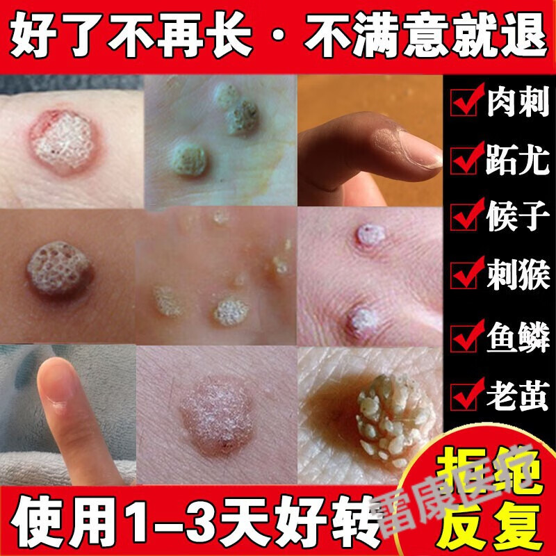 京健康子的药鱼鳞痣祛肉粒疙瘩治瘊子休子药刺猴药去除 刺猴药去除
