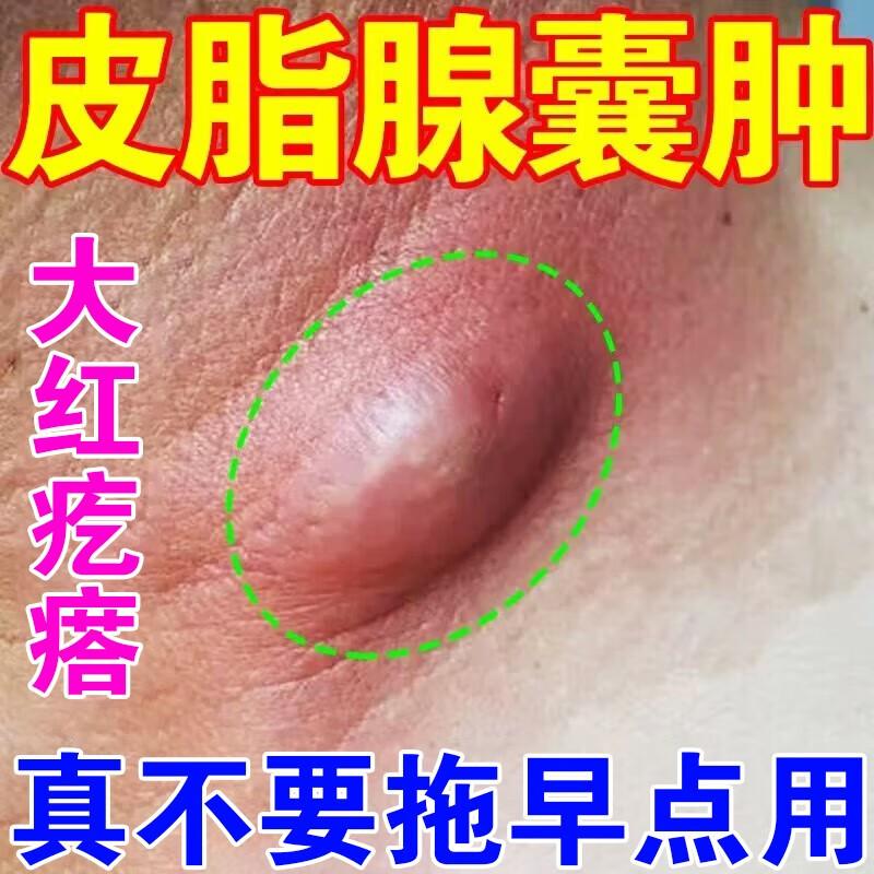 皮脂腺囊肿粉瘤痘痘去除膏消皮下脓包火疖子毒神器囊肿速消药 1盒【一