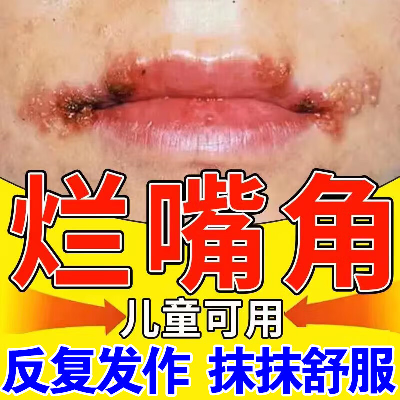 唇炎唇膏慢性唇炎干裂脱皮上火起泡口角炎成人儿童嘴唇干裂 单盒[不