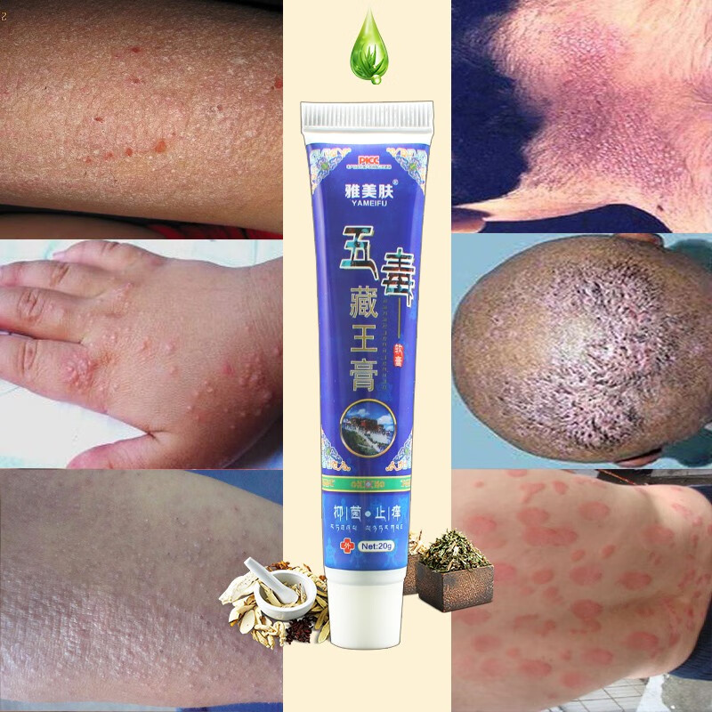 肤毒净病癣根净屑银癣外用癣痒灵皮肤止痒膏癣股治成人阴囊疹湿肛门瘙痒藓手草本癣痒净牛皮肤效癣足手斑汗雅美肤五毒藏王膏现货 虎窝购