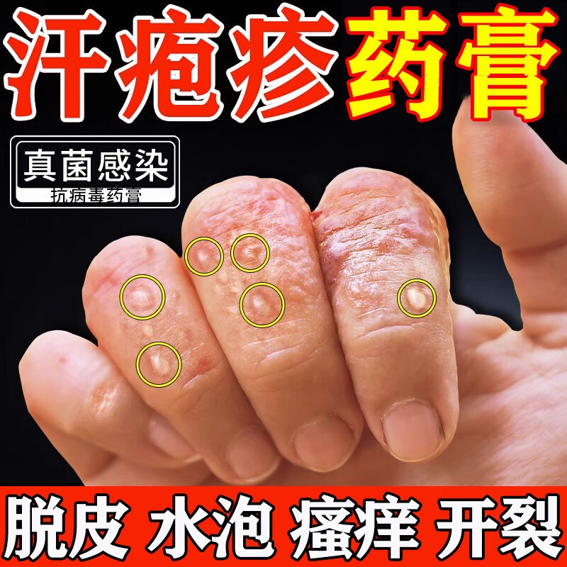 汗疱疹药膏手上起小水泡脱皮手痒 小水泡汗泡汗状泡疹软膏干裂止痒