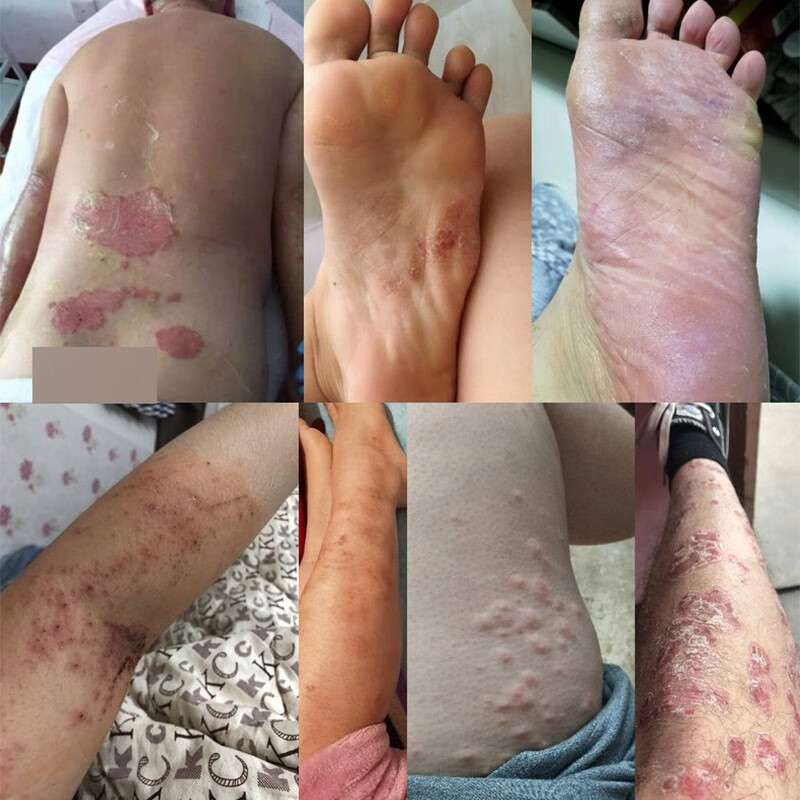 草本去牛皮肤体癣股癣手足屁股大腿根部痒炎皮疹湿止痒外用乳膏真菌