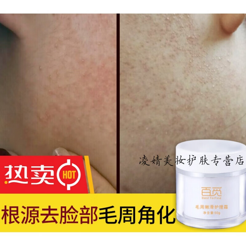 贵妇膏能去鸡皮肤吗(贵妇膏能修复激素脸吗) 贵妇膏能去鸡皮肤吗(贵妇膏能修复激素脸吗)