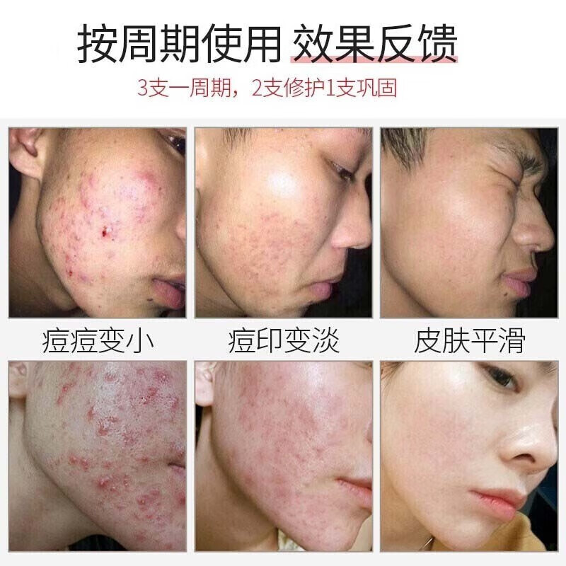 宫本武藏壬二酸祛痘膏15%凝胶皮傲宁祛痘印修复去痘疤淡化痘坑痤疮男女士 一盒装【轻度体验装】