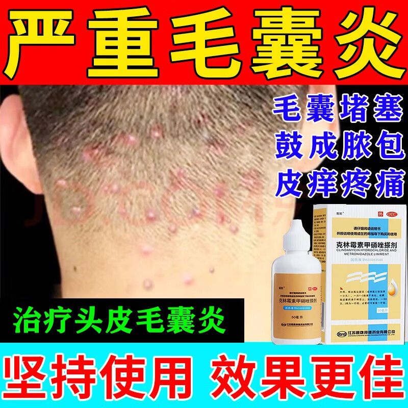 毛囊炎药专用药 头皮脸部背部胸部毛囊炎马拉色菌脂溢性皮炎小疙瘩