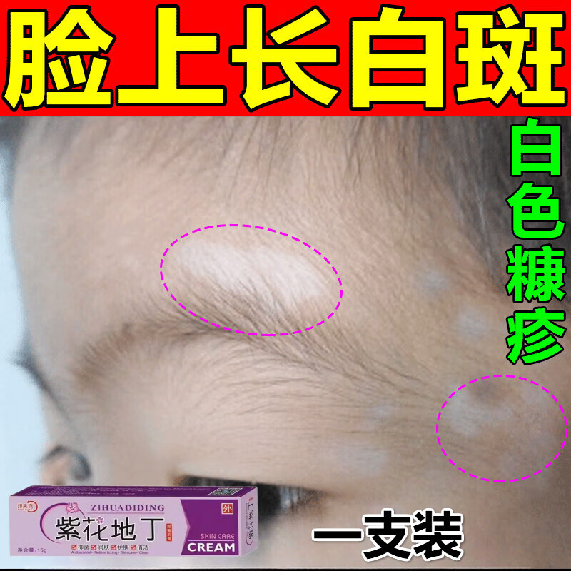 k&p白色糠l疹儿童用小孩脸上白斑虫斑瘙痒脸上干燥起皮 一支装
