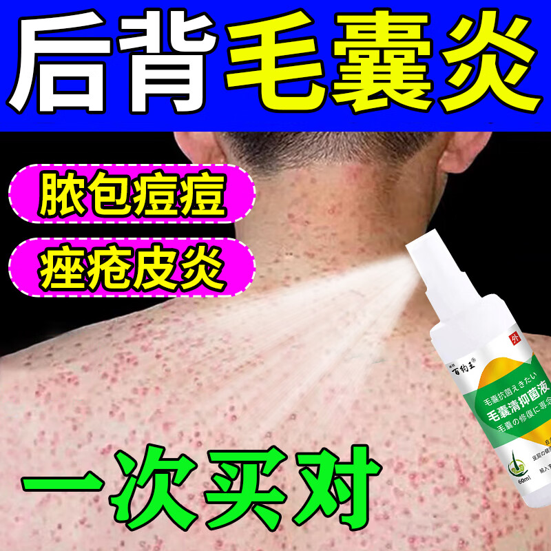 露卿沐后背祛痘毛囊炎背上长痘痘炎疮膏真菌感染脂溢性马拉色菌祛痘
