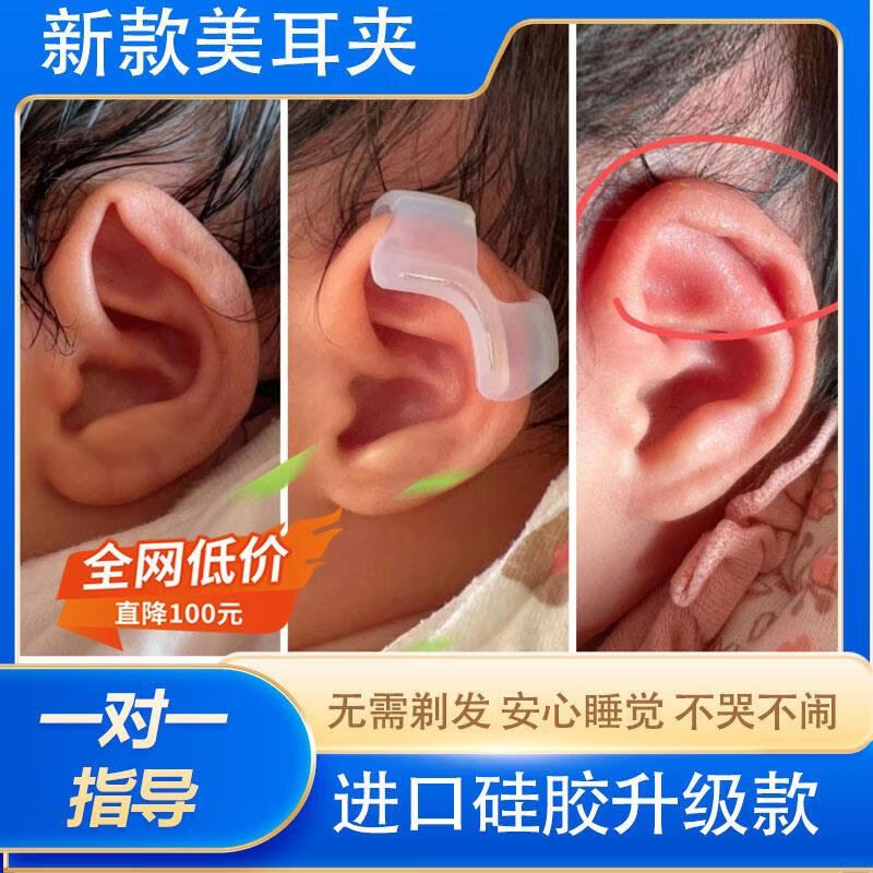 婴儿耳朵矫正器固定  新生儿耳廓耳朵夹器耳撑耳形外耳内扣固定垂耳贴