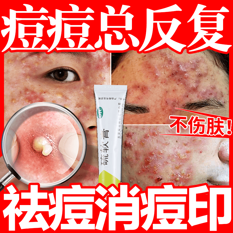 痤疮用药膏祛痘药膏脓疱疮毛囊炎青春痘脸上螨虫除螨祛痘印淡化痘印