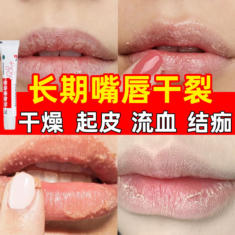 红霉素软膏 1盒装【口角炎烂嘴角)