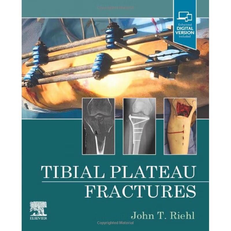 预定tibial plateau fractures胫骨平台骨折