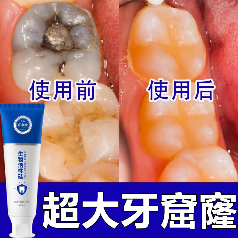 蛀牙洞复修龋齿 再生硅牙膏日本监制补牙齿洞膏牙缝补蛀牙齿自己清理