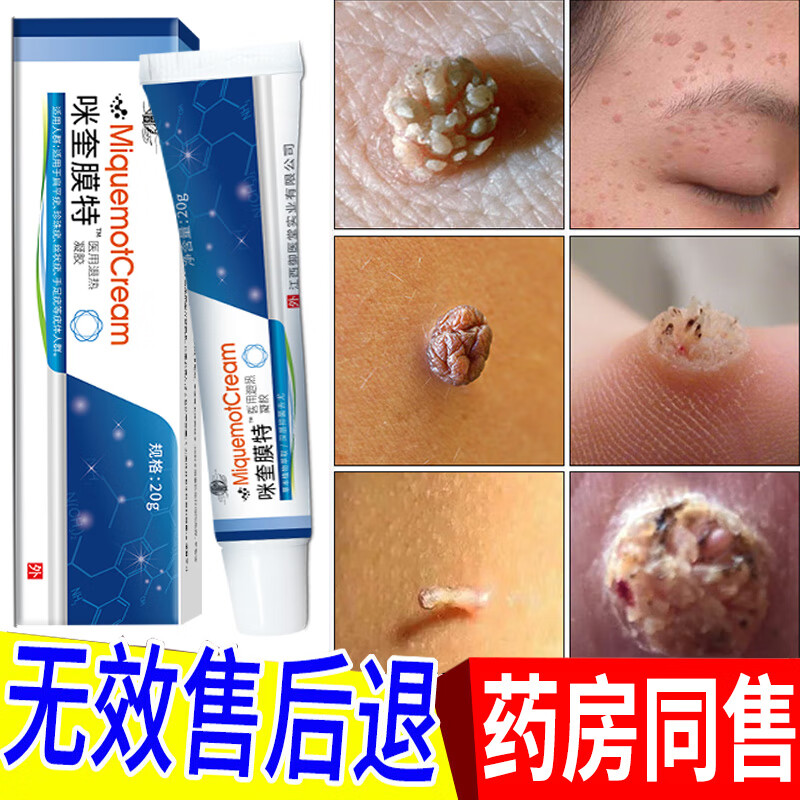 专用非药去 疣灵肉粒跖疣瘊猴子去除脖子小肉粒尖锐湿疣丝状疣夫密码