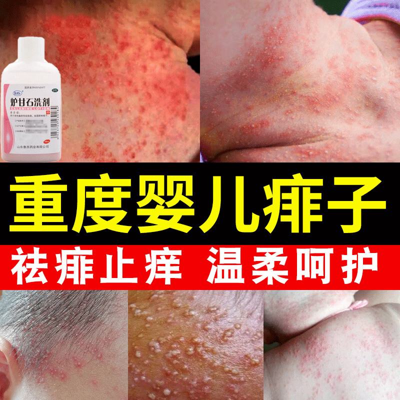 治热痱子婴儿专用止痒 痱子水祛痱止痒 皮肤瘙痒水疱痱子药幼儿宝宝