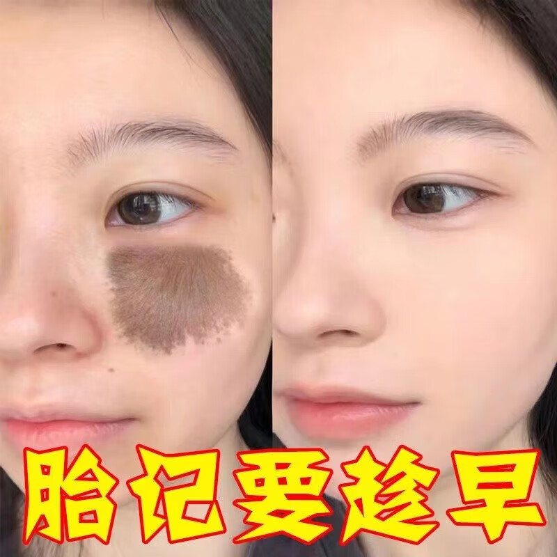 nhfouyou胎记去除膏神器脸上黑色素天生胎记咖啡斑淡化红色去祛除专用