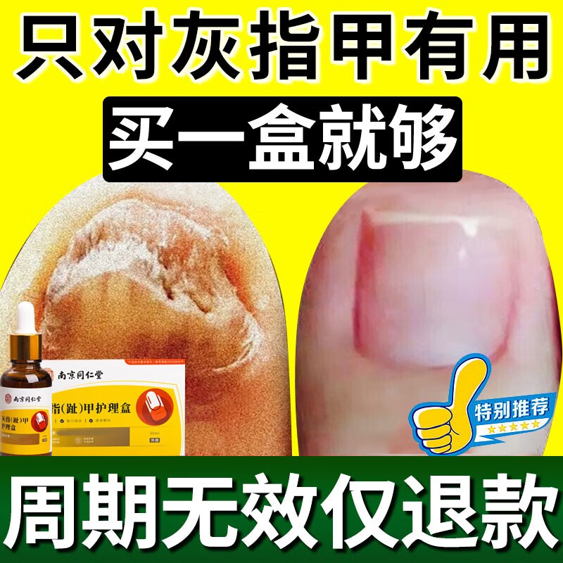 南京同仁堂灰指甲特殊效去除甲i沟i炎增厚发黄变空液中草药水灰甲 1盒装【1-2个推荐】怎么样,好用不?
