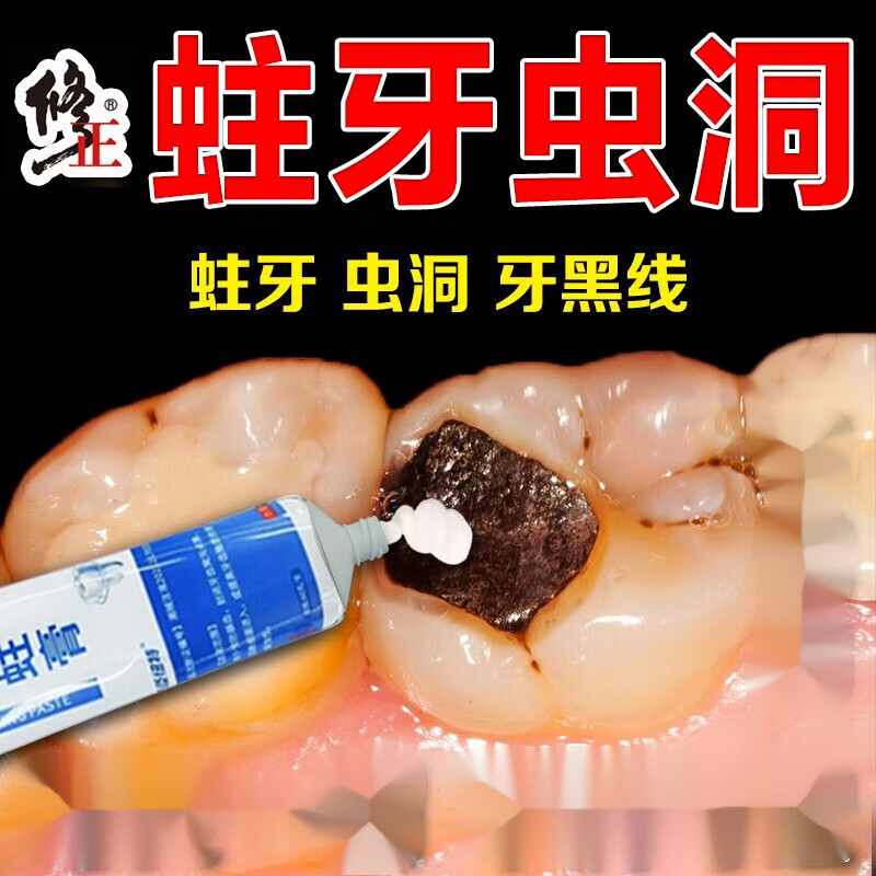 防蛀修补修复膏牙洞儿童成人牙釉质损伤蛀牙虫牙龋齿牙黑线牙缝宽 一