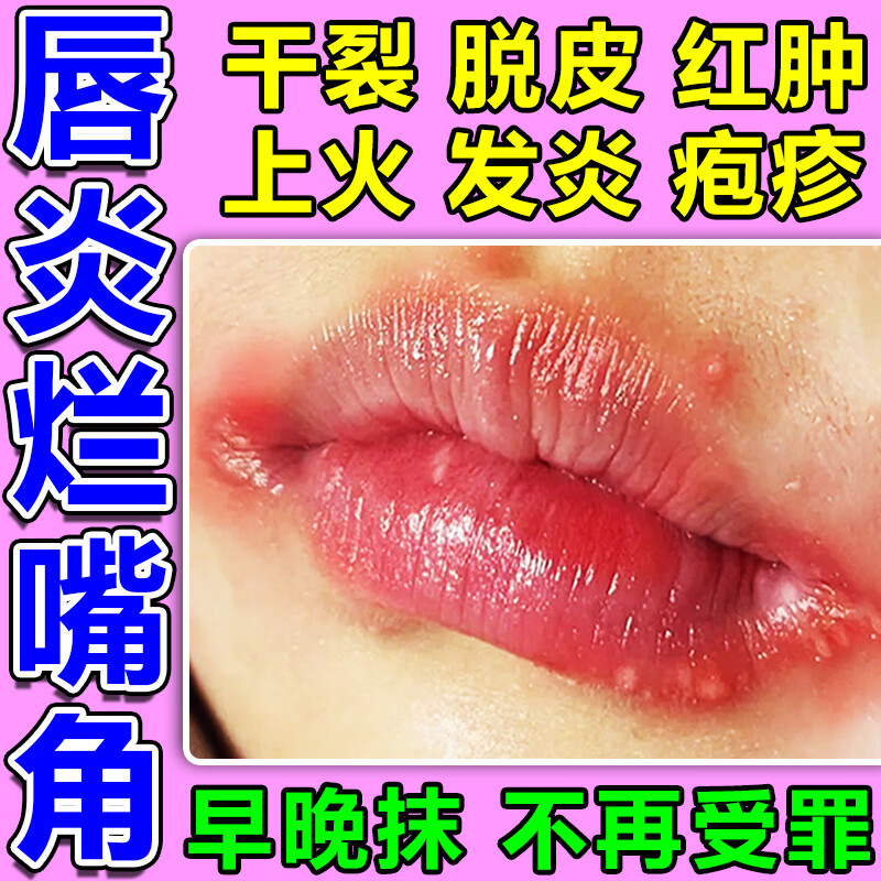 唇炎专用药慢性唇炎嘴唇干裂脱皮口角炎上火起泡红肿出血干裂舌炎舌头