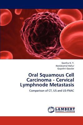 预订Oral Squamous Cell Carcinoma - Cervical Lymphnod