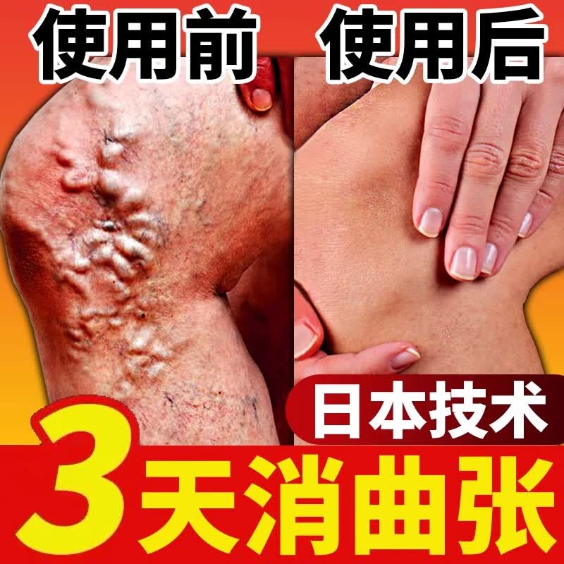 乔记本草日本静脉曲张专用非药进口蚯蚓腿红血丝静脉曲张脉络舒通冷敷